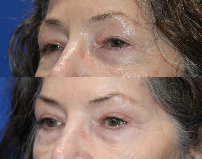 Ptosis Repair Before & After Gallery - Patient 223474 - Image 4