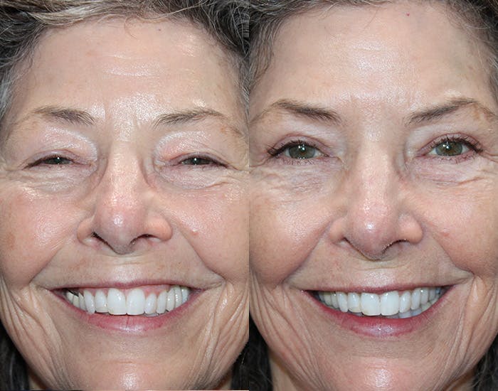 Ptosis Repair Before & After Gallery - Patient 223474 - Image 5