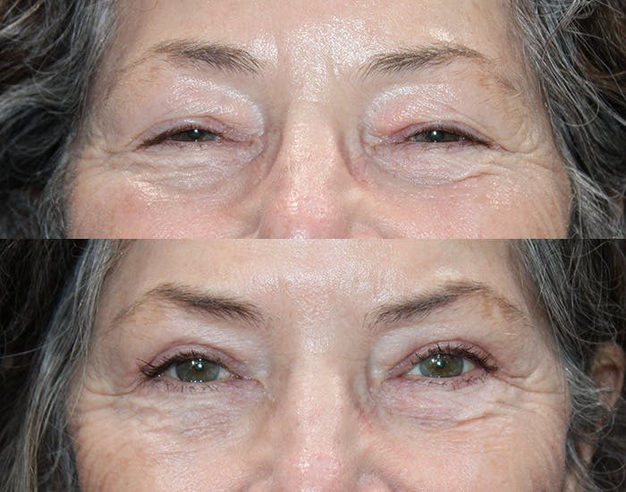 Ptosis Repair Before & After Gallery - Patient 223474 - Image 6