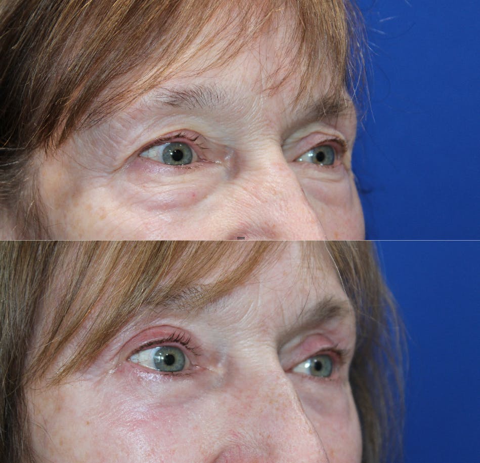 Full Circle Before & After Gallery - Patient 976255 - Image 2