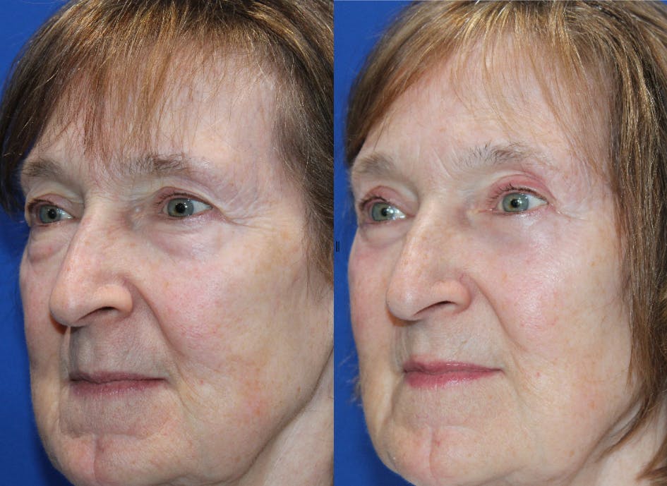 Full Circle Before & After Gallery - Patient 976255 - Image 4