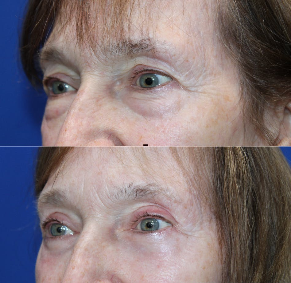 Full Circle Before & After Gallery - Patient 976255 - Image 3