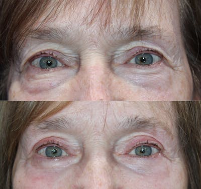 Full Circle Before & After Gallery - Patient 976255 - Image 1