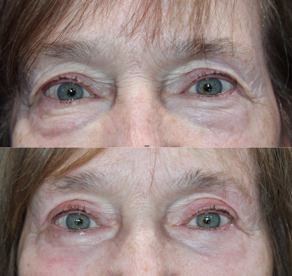 Full Circle Before & After Gallery - Patient 976255 - Image 1