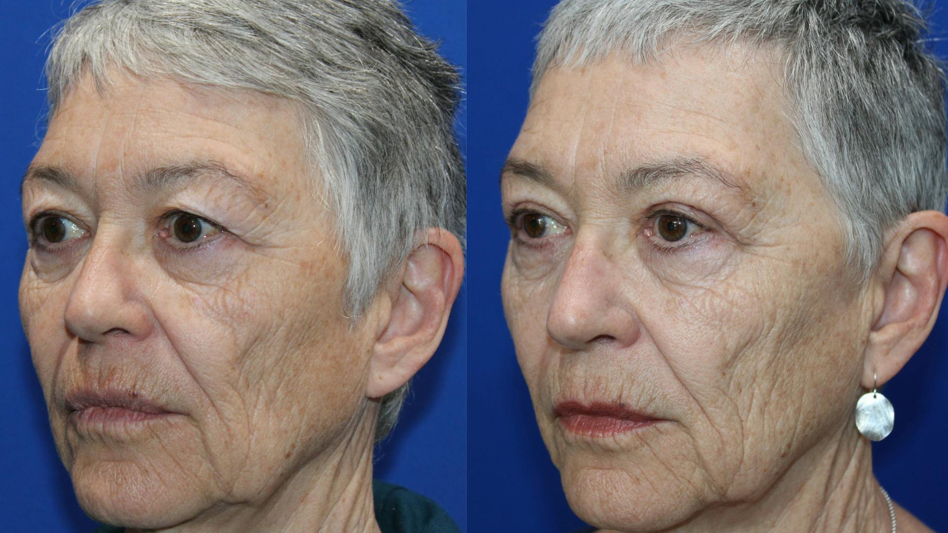 Upper Blepharoplasty Before & After Gallery - Patient 737412 - Image 2