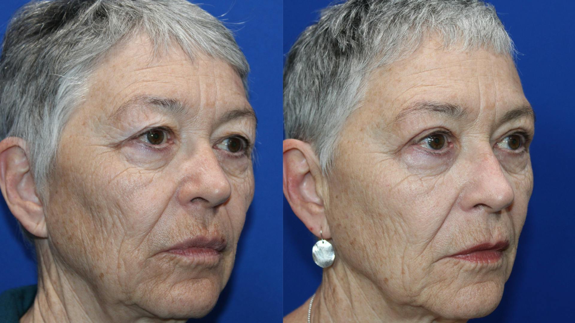 Upper Blepharoplasty Before & After Gallery - Patient 737412 - Image 3