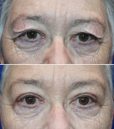Upper Blepharoplasty Before & After Gallery - Patient 737412 - Image 1