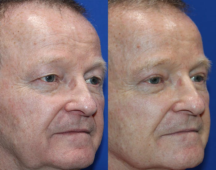 Upper Blepharoplasty Before & After Gallery - Patient 106406 - Image 3