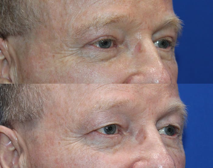 Upper Blepharoplasty Before & After Gallery - Patient 106406 - Image 4