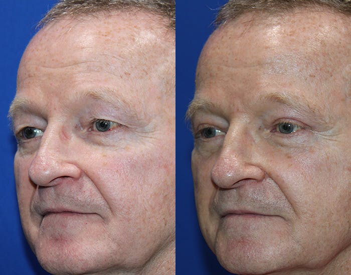 Upper Blepharoplasty Before & After Gallery - Patient 106406 - Image 5
