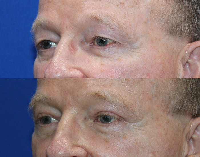 Upper Blepharoplasty Before & After Gallery - Patient 106406 - Image 6