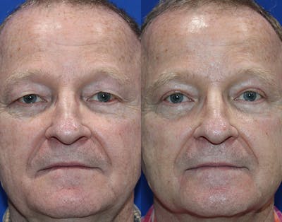 Upper Blepharoplasty Before & After Gallery - Patient 106406 - Image 1