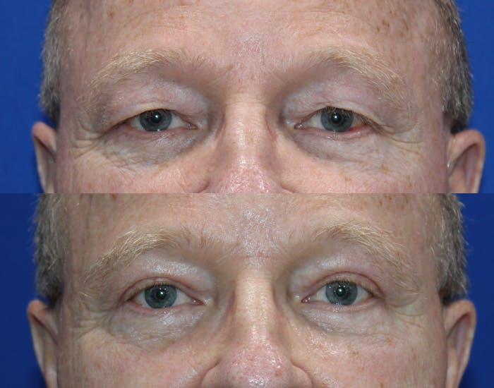 Upper Blepharoplasty Before & After Gallery - Patient 106406 - Image 2