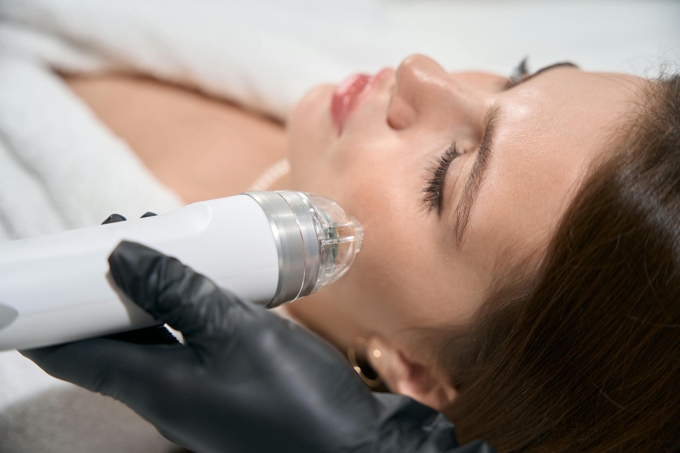 Woman getting Microneedling