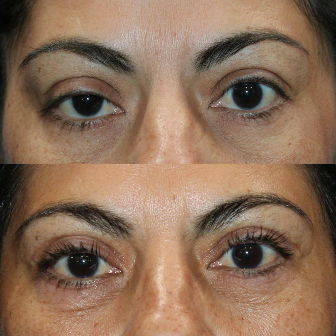 Upper Blepharoplasty Before & After Gallery - Patient 309599 - Image 2