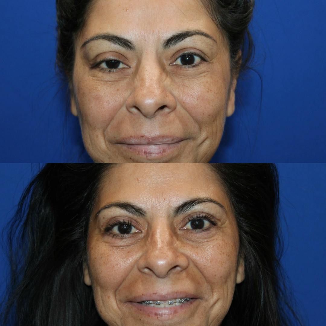 Upper Blepharoplasty Before & After Gallery - Patient 309599 - Image 3