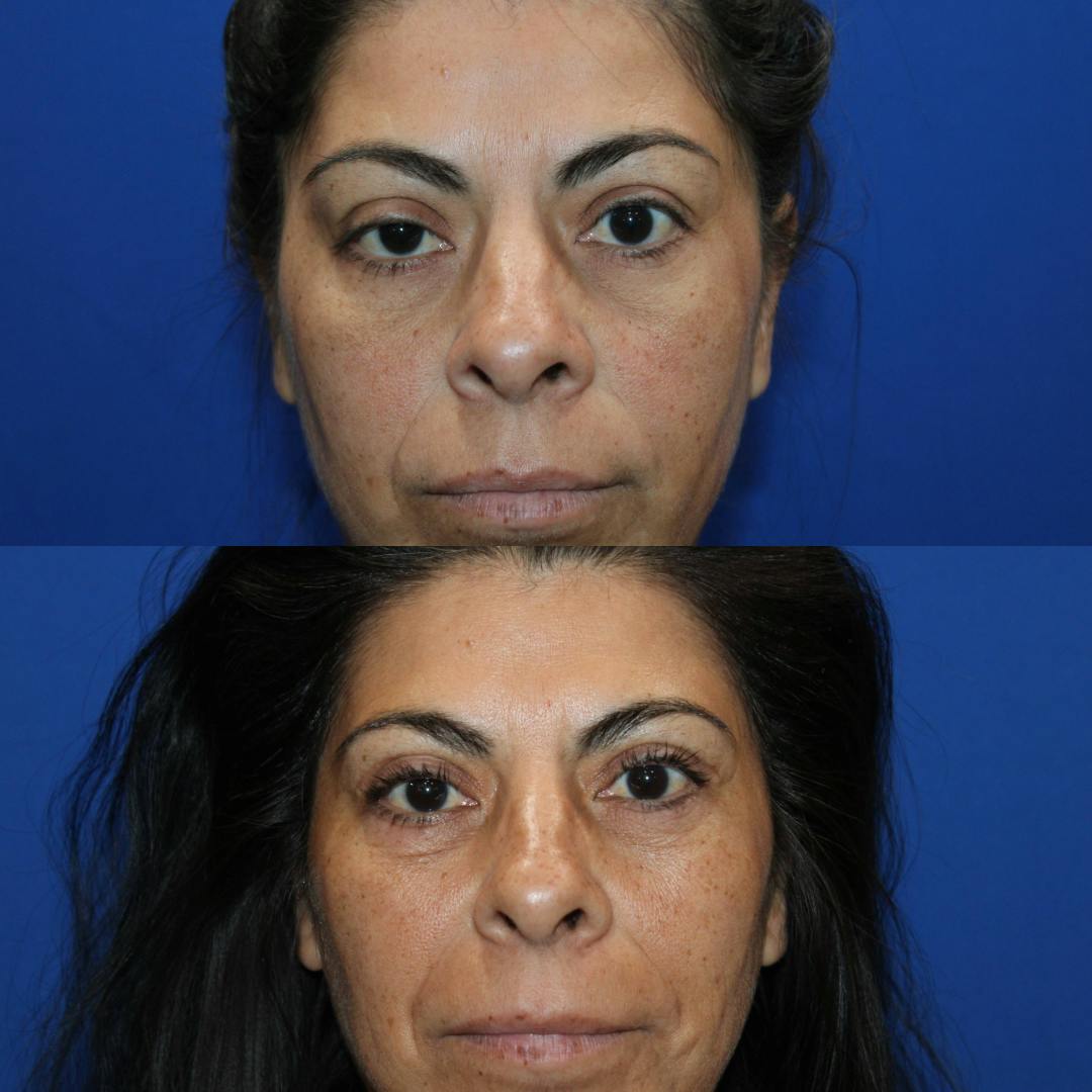 Upper Blepharoplasty Before & After Gallery - Patient 309599 - Image 1