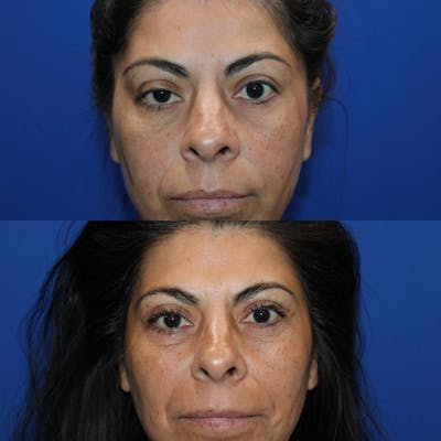 Upper Blepharoplasty Before & After Gallery - Patient 309599 - Image 1