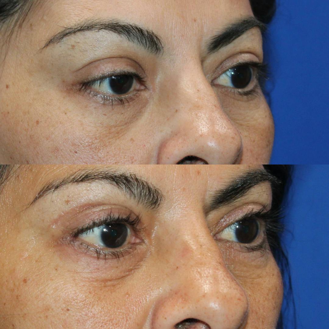 Upper Blepharoplasty Before & After Gallery - Patient 309599 - Image 4