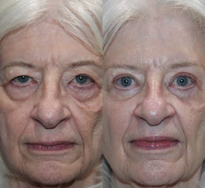Full Circle Before & After Gallery - Patient 109883 - Image 1