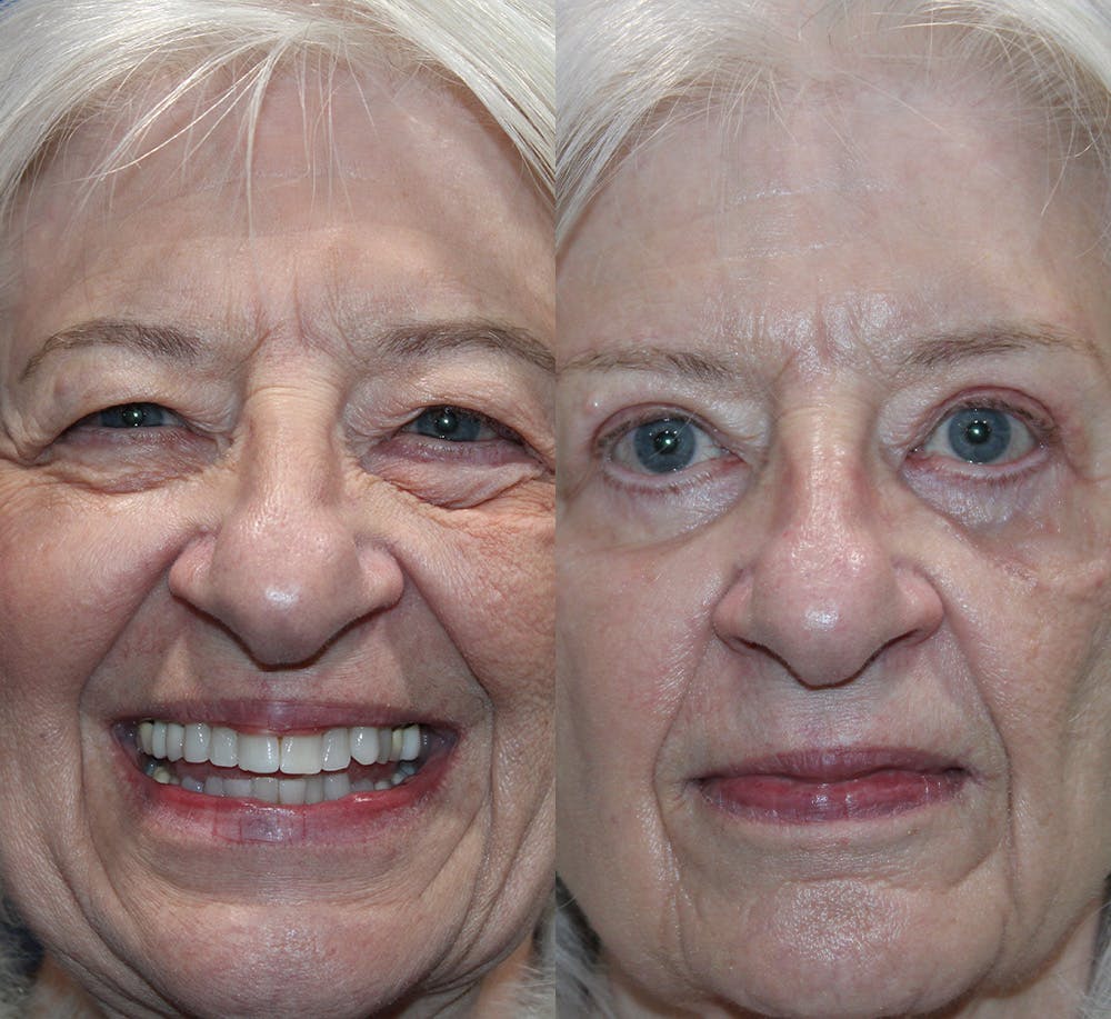 Full Circle Before & After Gallery - Patient 109883 - Image 3