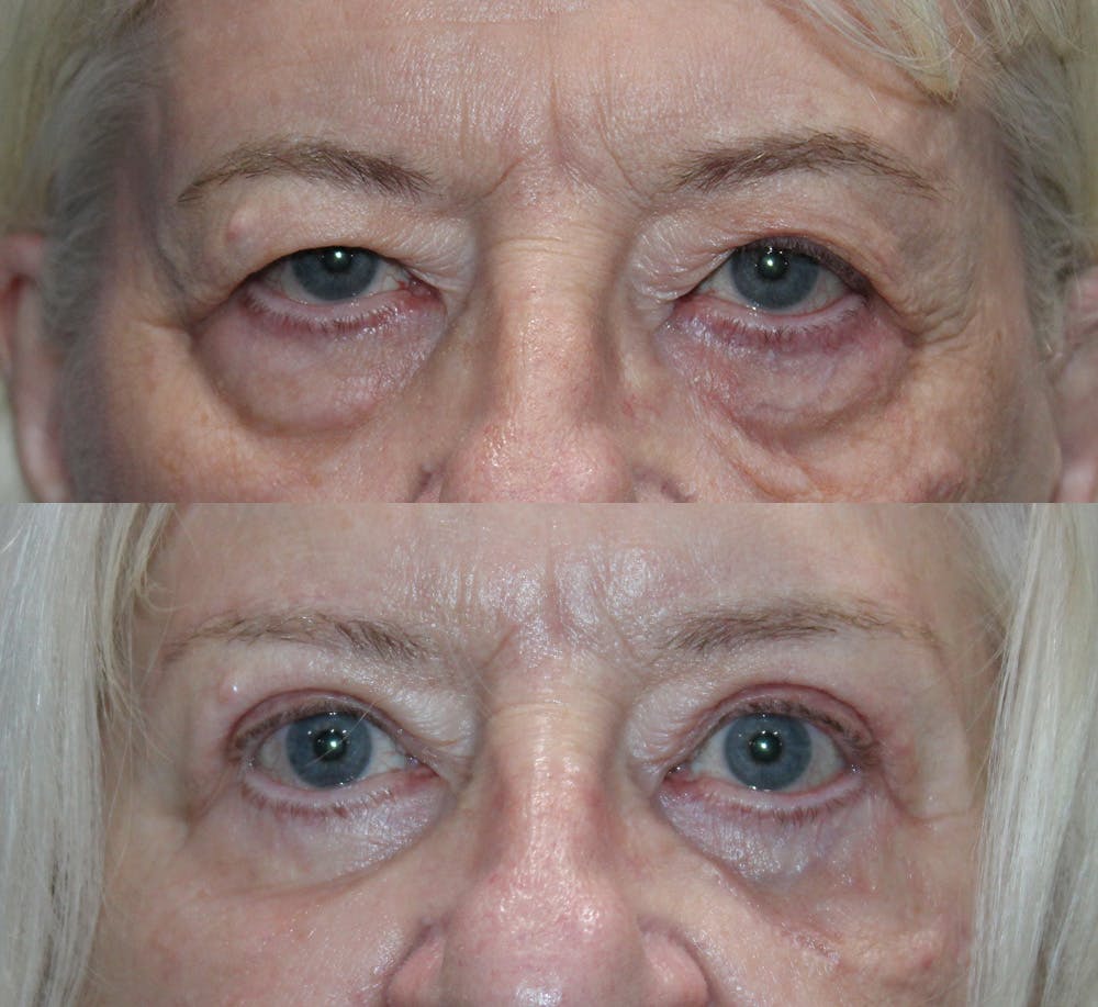 Full Circle Before & After Gallery - Patient 109883 - Image 2