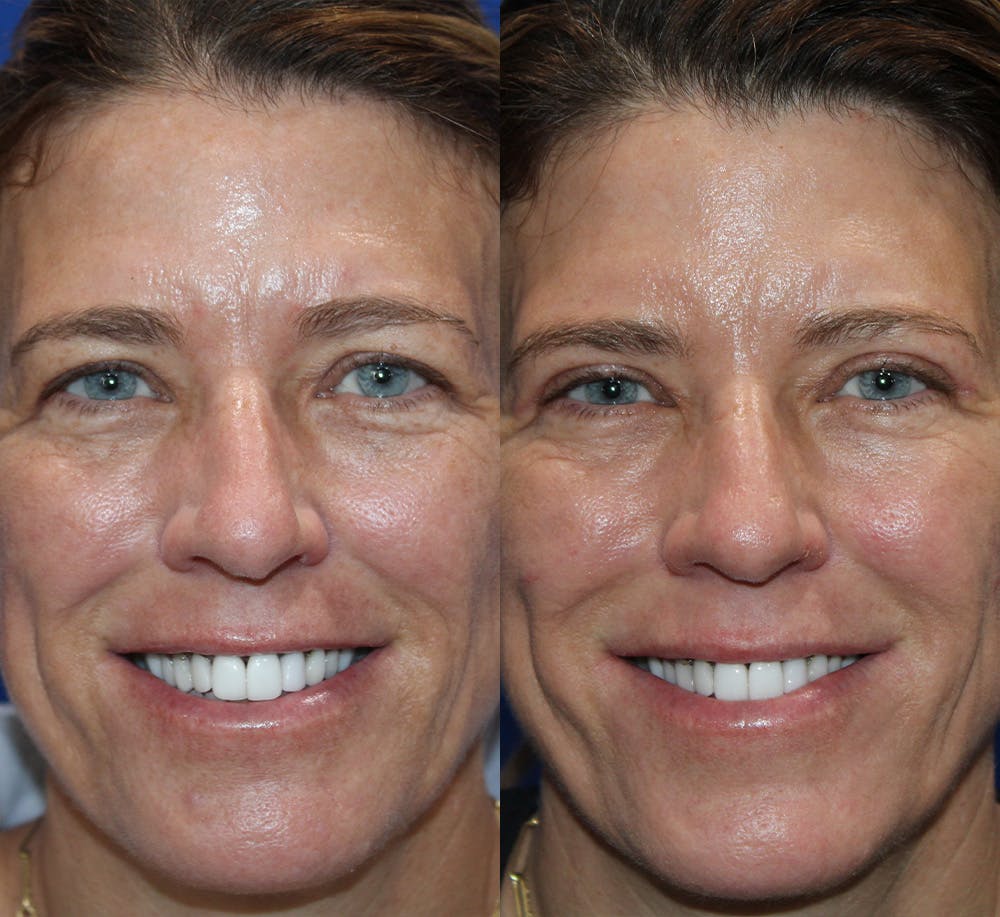Upper Blepharoplasty Before & After Gallery - Patient 339558 - Image 2