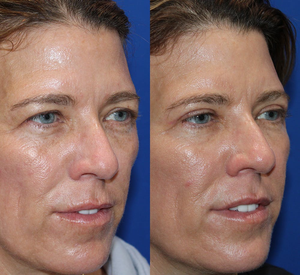 Upper Blepharoplasty Before & After Gallery - Patient 339558 - Image 3