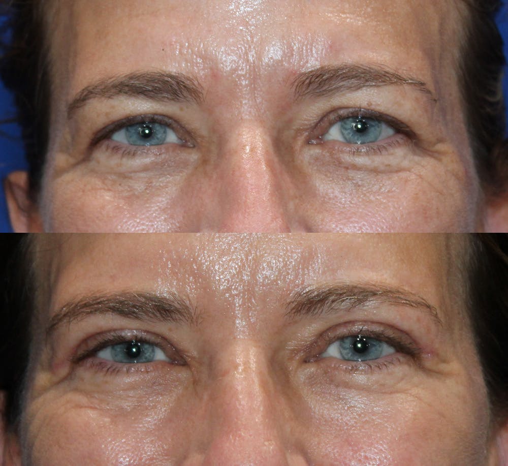 Upper Blepharoplasty Before & After Gallery - Patient 339558 - Image 5