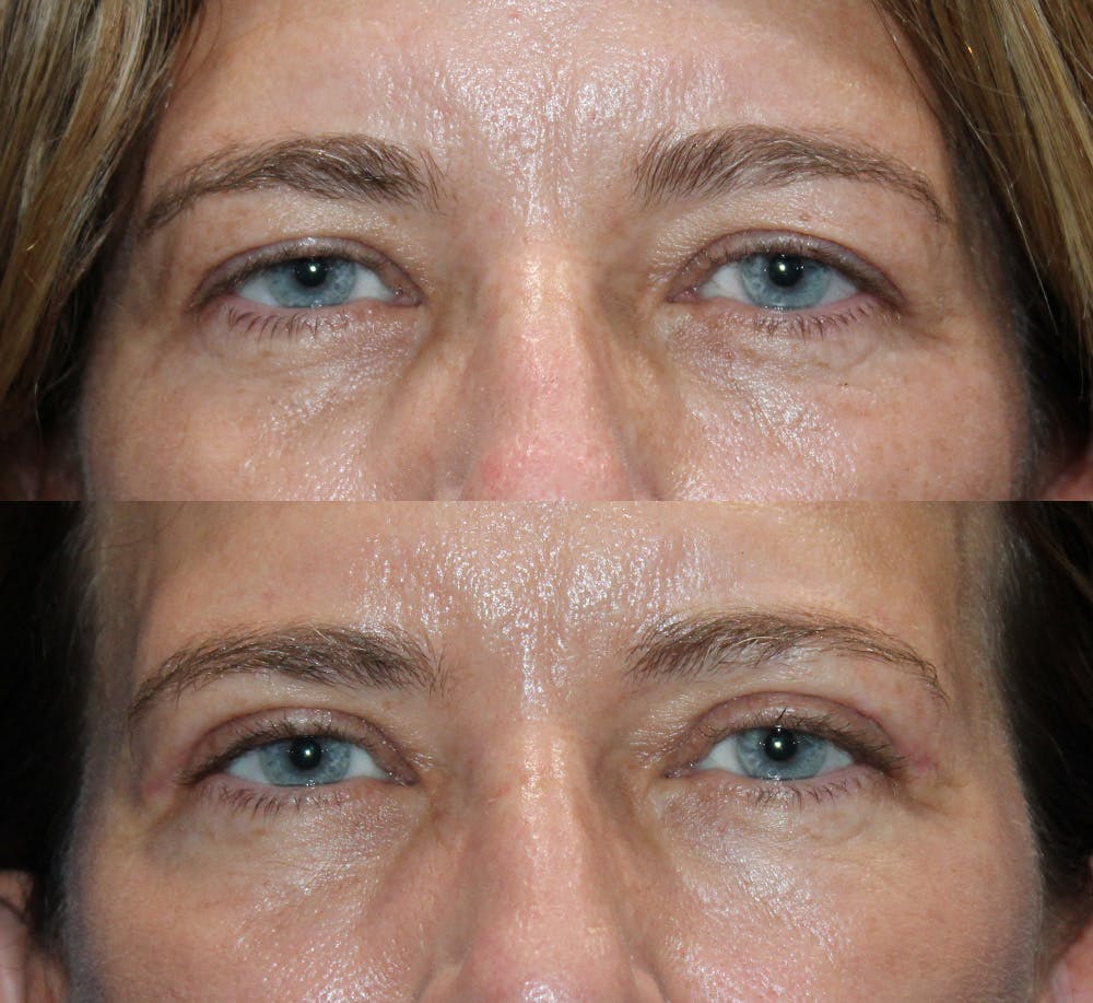 Upper Blepharoplasty Before & After Gallery - Patient 339558 - Image 4