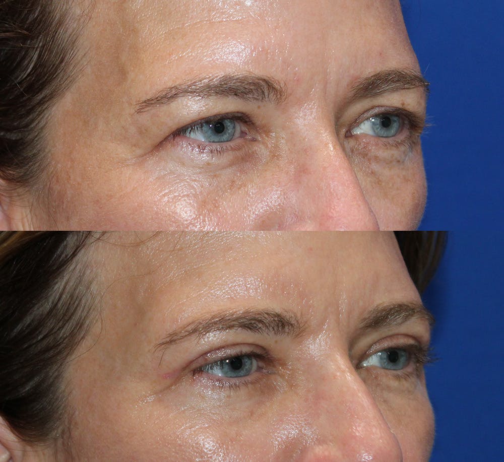 Upper Blepharoplasty Before & After Gallery - Patient 339558 - Image 6