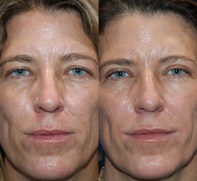 Upper Blepharoplasty Before & After Gallery - Patient 339558 - Image 1