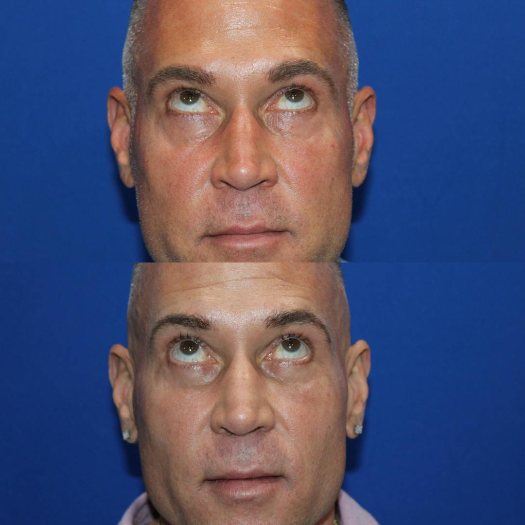 Lower Blepharoplasty Before & After Gallery - Patient 340140 - Image 2