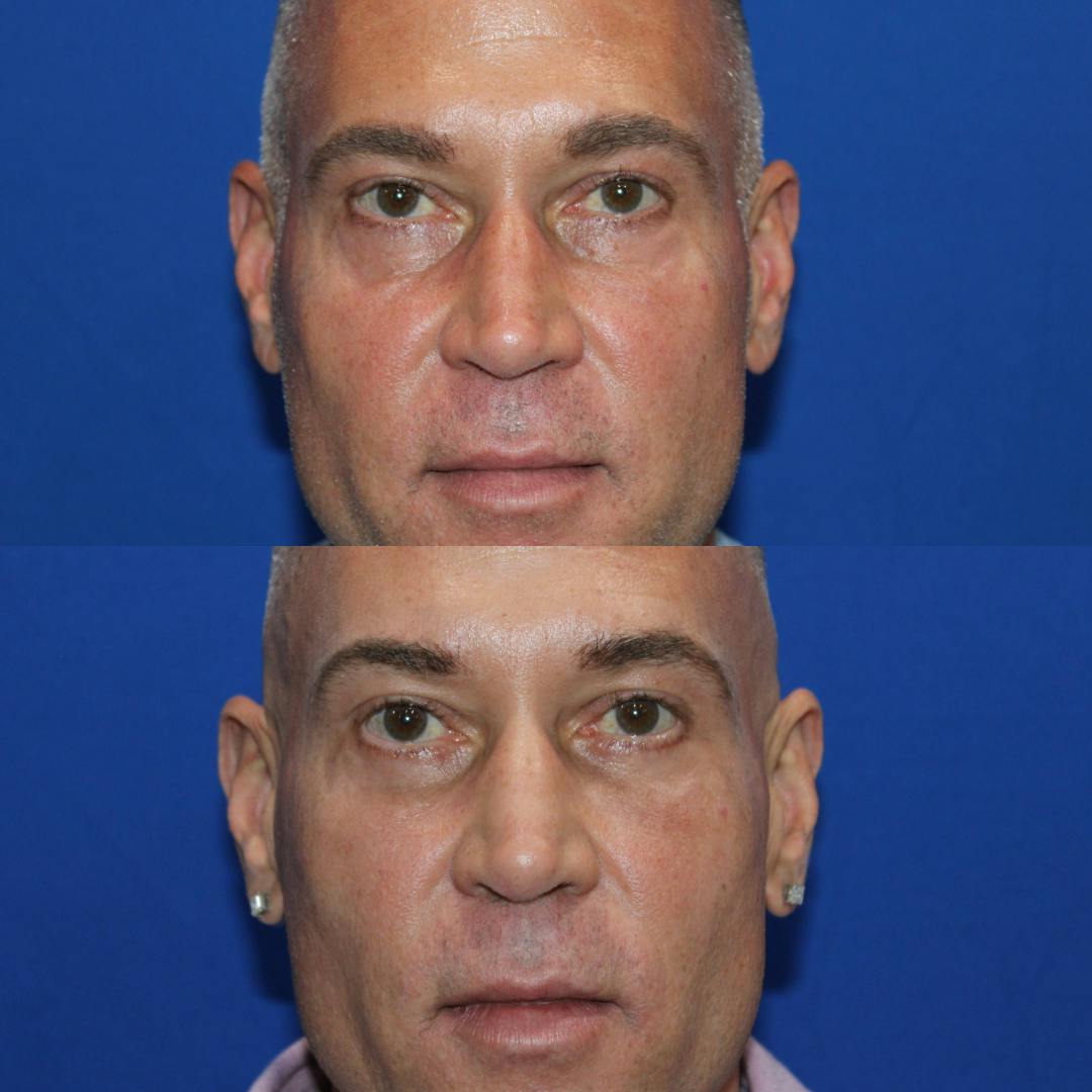 Lower Blepharoplasty Before & After Gallery - Patient 340140 - Image 1