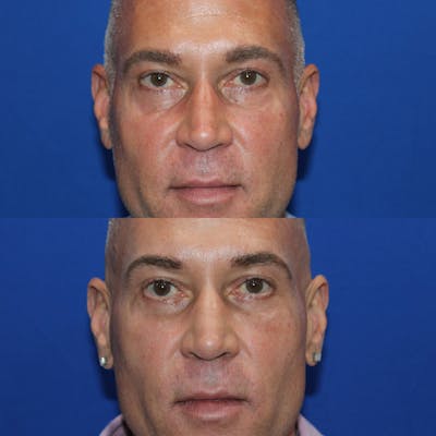 Lower Blepharoplasty Before & After Gallery - Patient 340140 - Image 1