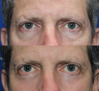 Lower Blepharoplasty Before & After Gallery - Patient 150681 - Image 1