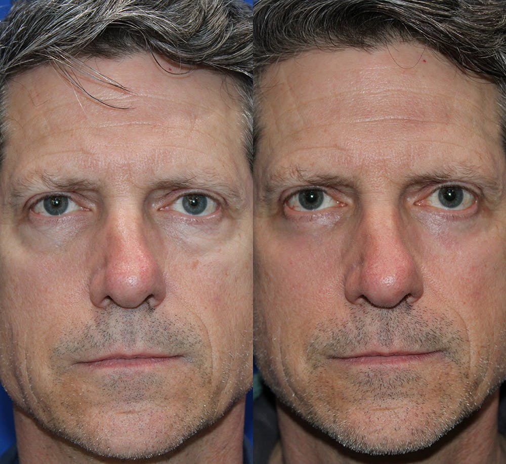 Lower Blepharoplasty Before & After Gallery - Patient 150681 - Image 2