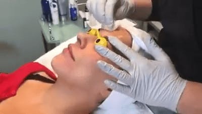 woman getting a face procedure