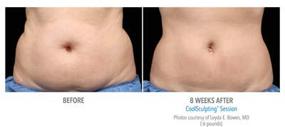 stomach coolsculpting before and after
