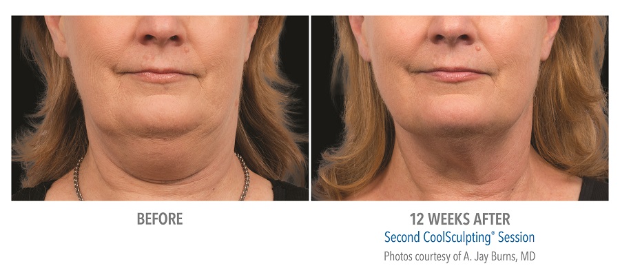 chin before and after coolsculpting