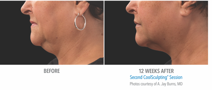 coolsculpting of chin before and after