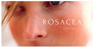 person with rosacea