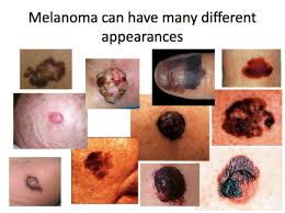 examples of melanoma