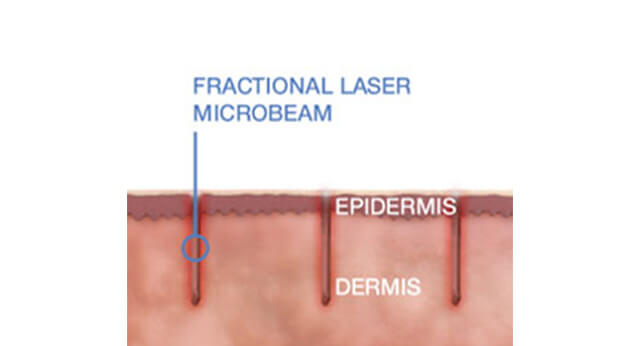 How Does it Work? - Fractional Laser Microbream Graphic