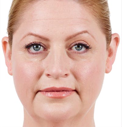 Facial Fillers Before & After Gallery - Patient 65918843 - Image 1