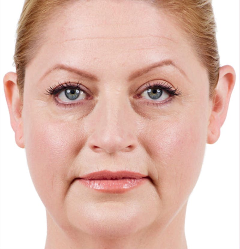 Facial Fillers Before & After Gallery - Patient 65918843 - Image 1
