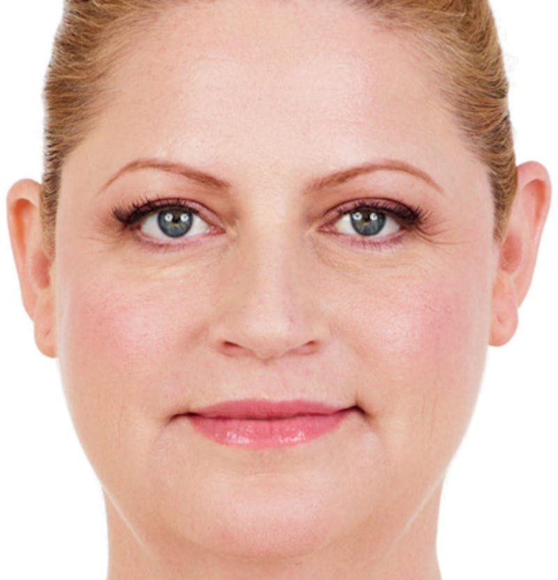Facial Fillers Before & After Gallery - Patient 65918843 - Image 2
