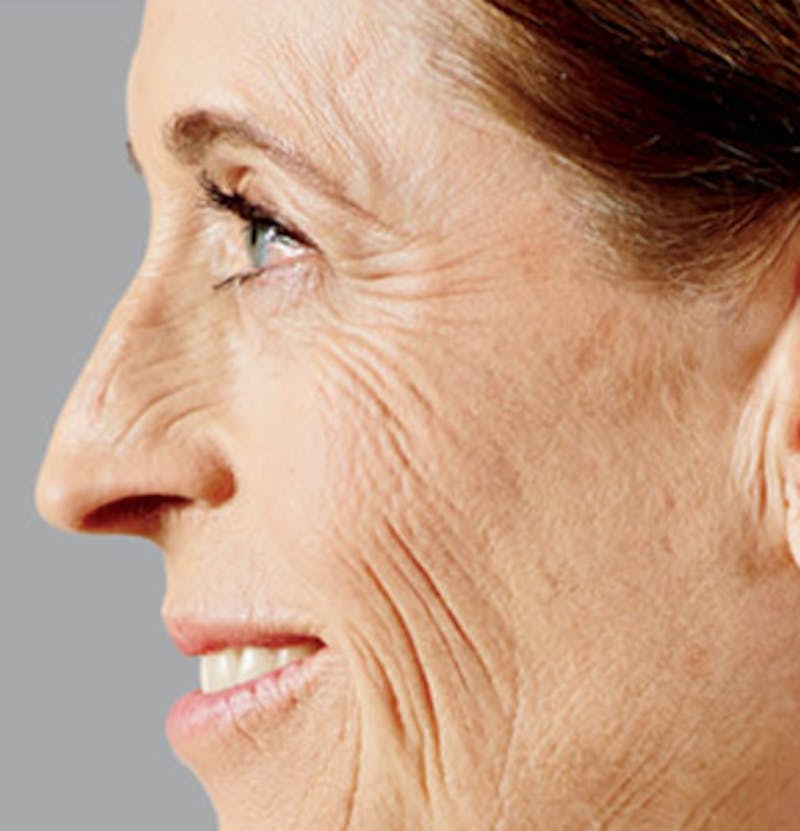 Facial Fillers Before & After Gallery - Patient 65918844 - Image 3