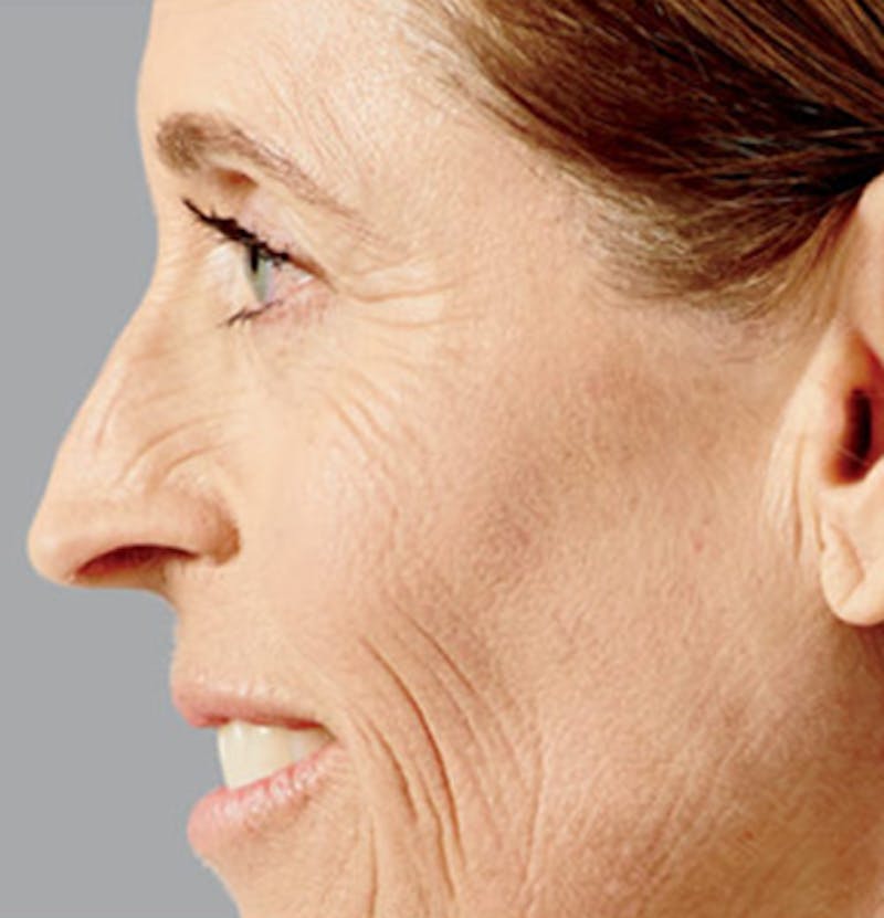 Facial Fillers Before & After Gallery - Patient 65918844 - Image 4