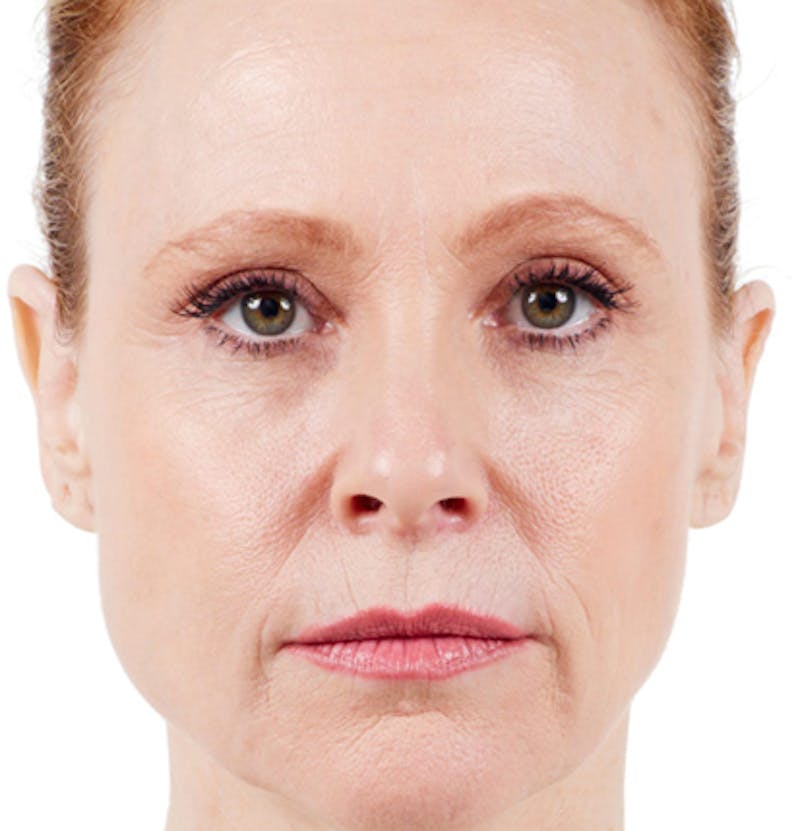 Facial Fillers Before & After Gallery - Patient 65918902 - Image 1